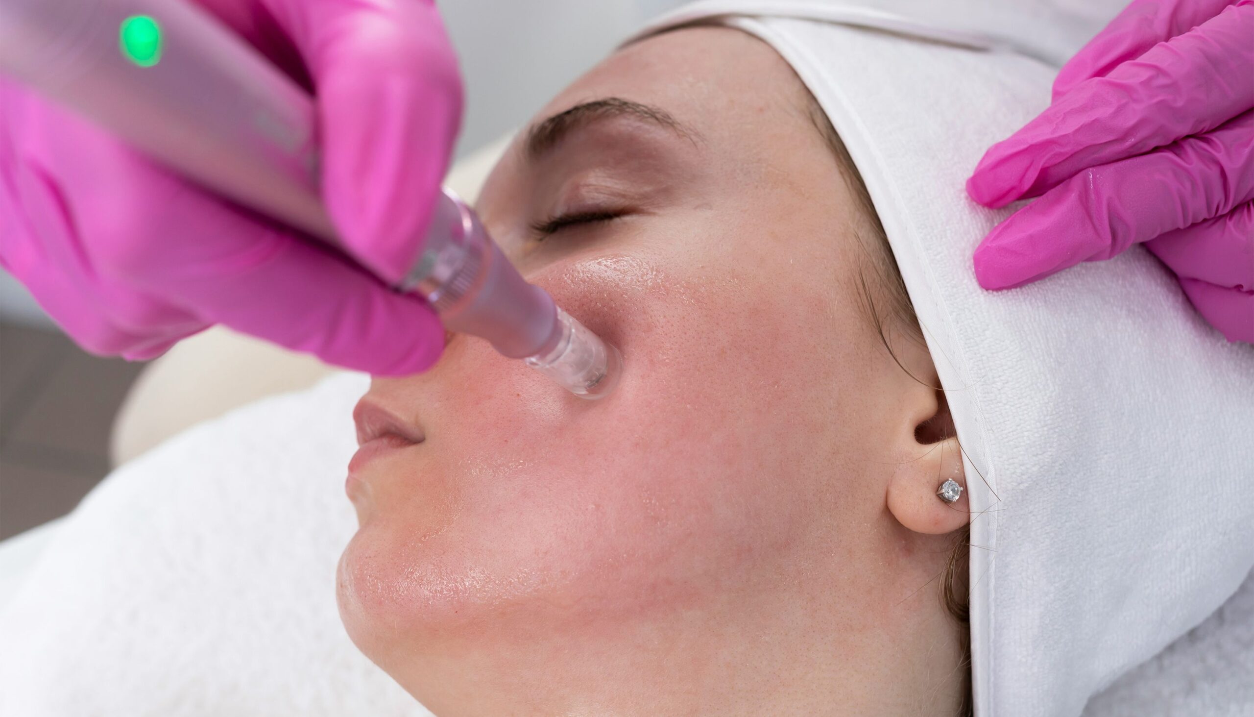 Is It Safe to Get Microneedling in the Summer? We Asked the Experts