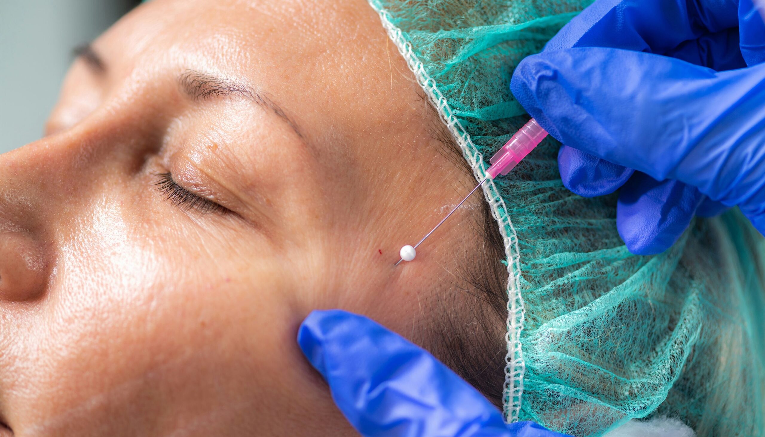 Should You Get a Thread Lift? Doctors Debate