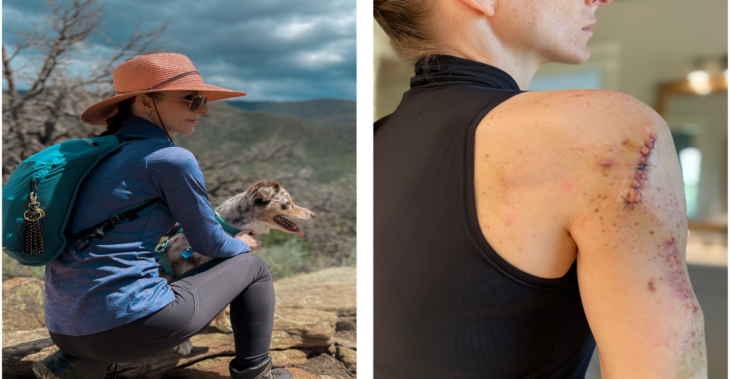 I Was the Pale Girl in High School—Now I'm a Four-Time Melanoma Survivor