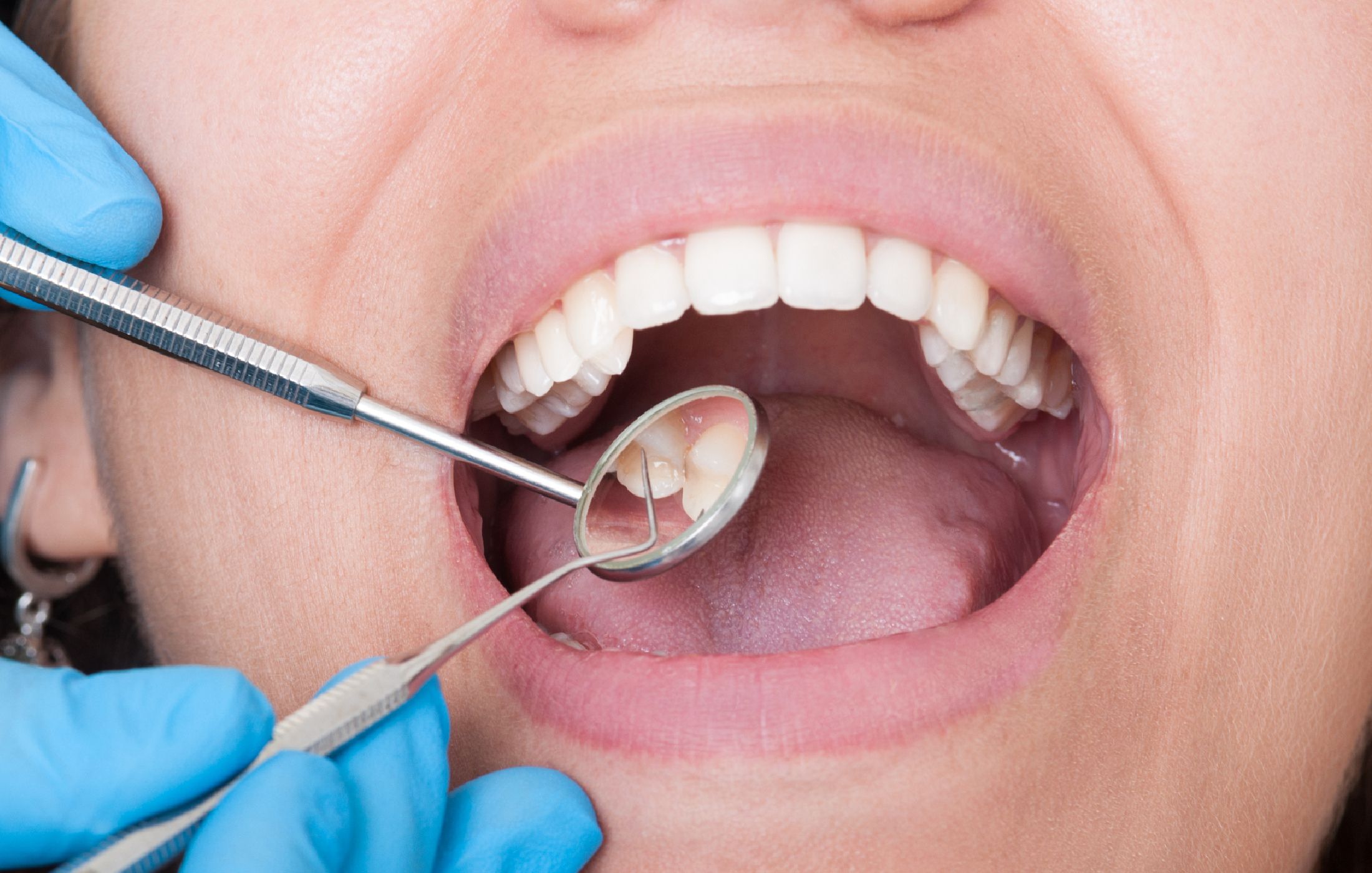 Turns Out a Cavity Doesn't Always Need a Drill