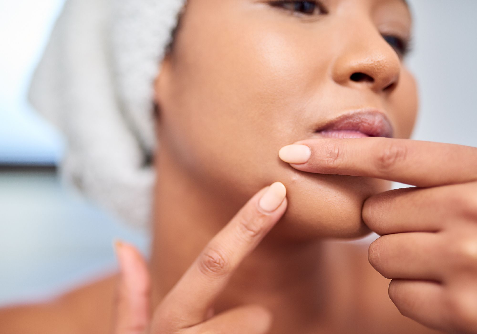 Why Your Chin Keeps Breaking Out, and How to Finally Stop It