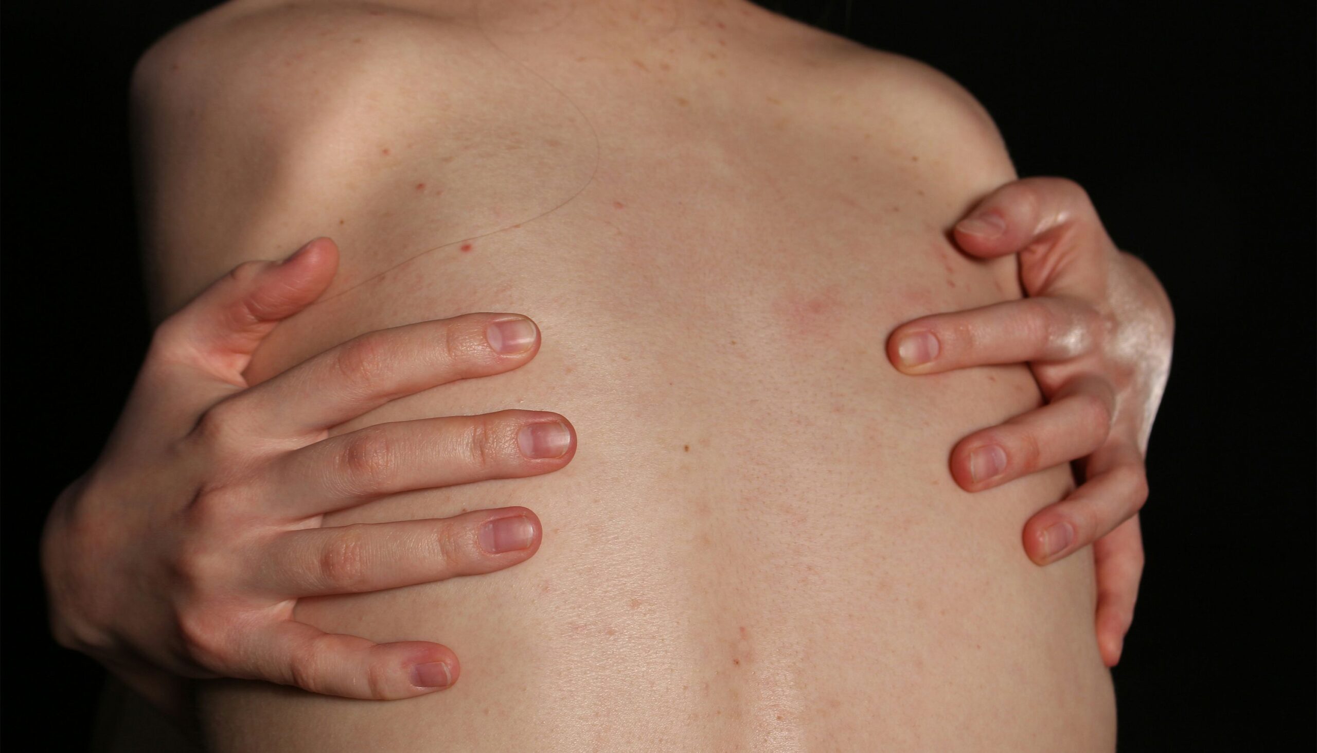 From Friction to Heat: The Everyday Triggers Behind Chronic Hives
