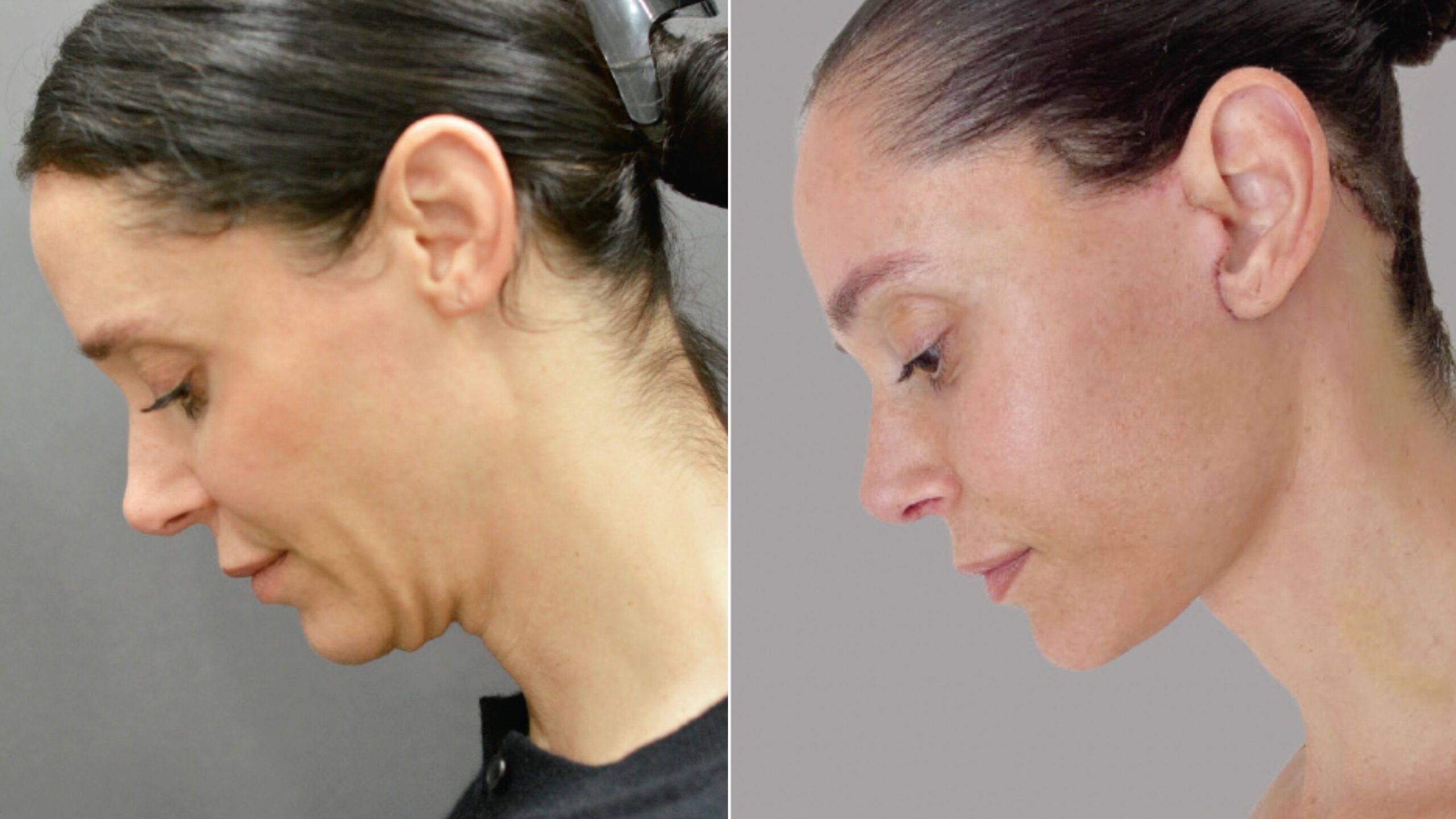 Inside the Rise of the 40-Something Facelift