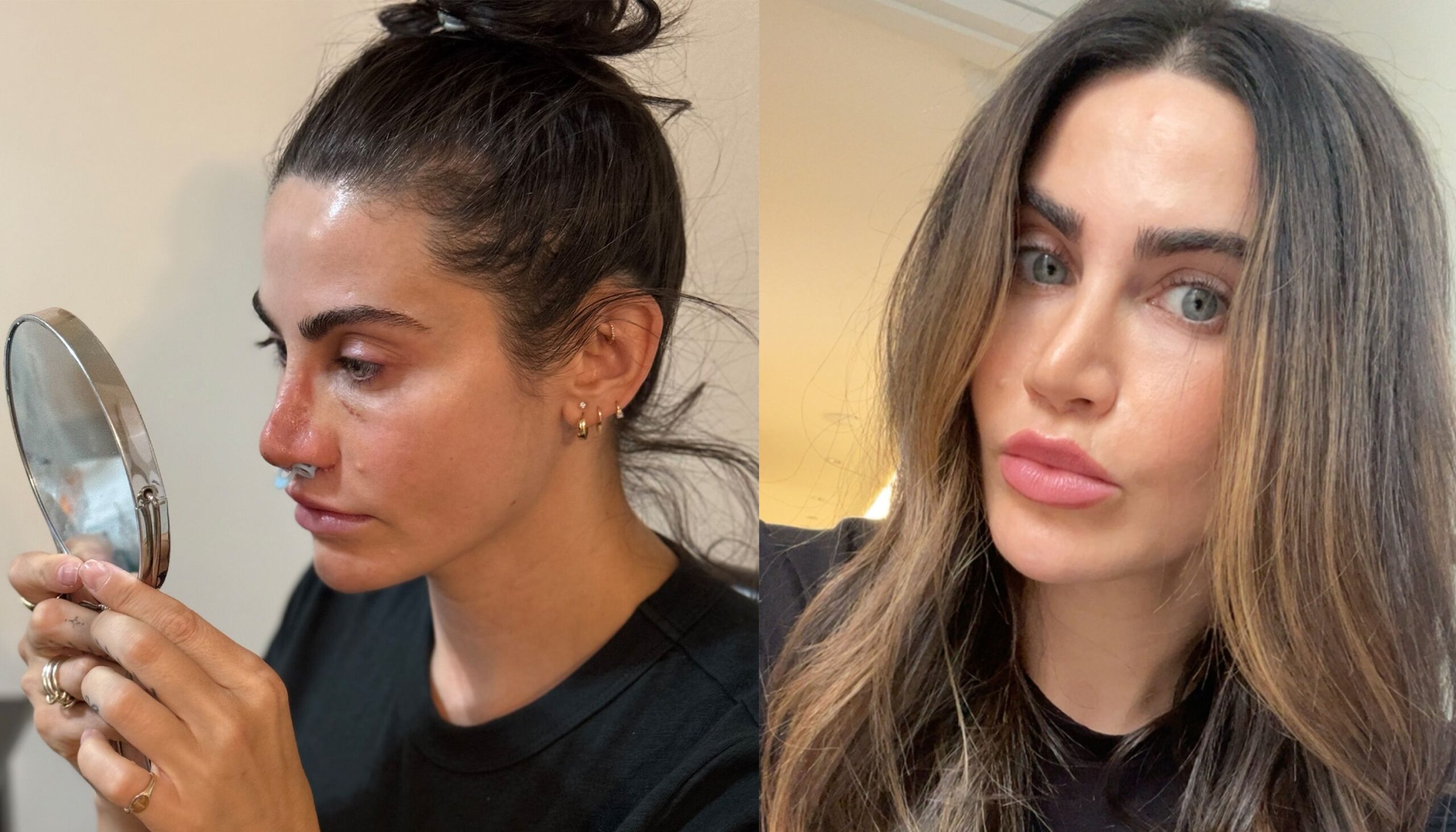 I Got a Rhinoplasty as a Beauty Editor—Here’s My Honest Review, One Year Later