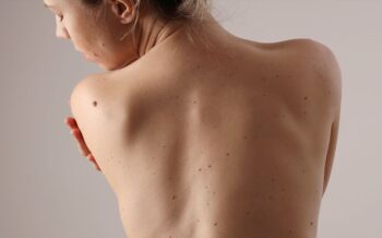 How to Tell the Difference Between Skin Cancer and a Pimple