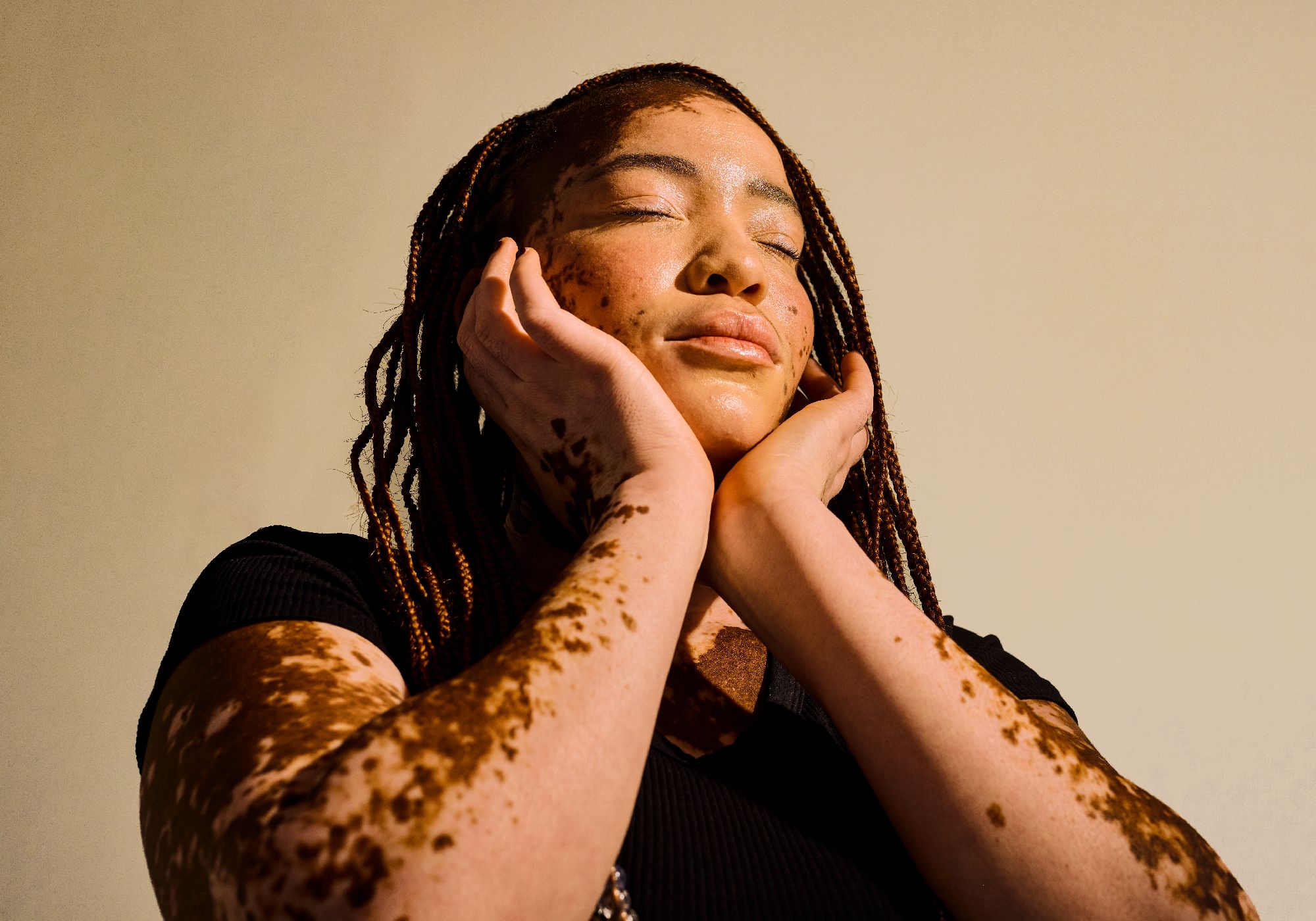 Vitiligo Affects More Than Skin, a New Survey Finds