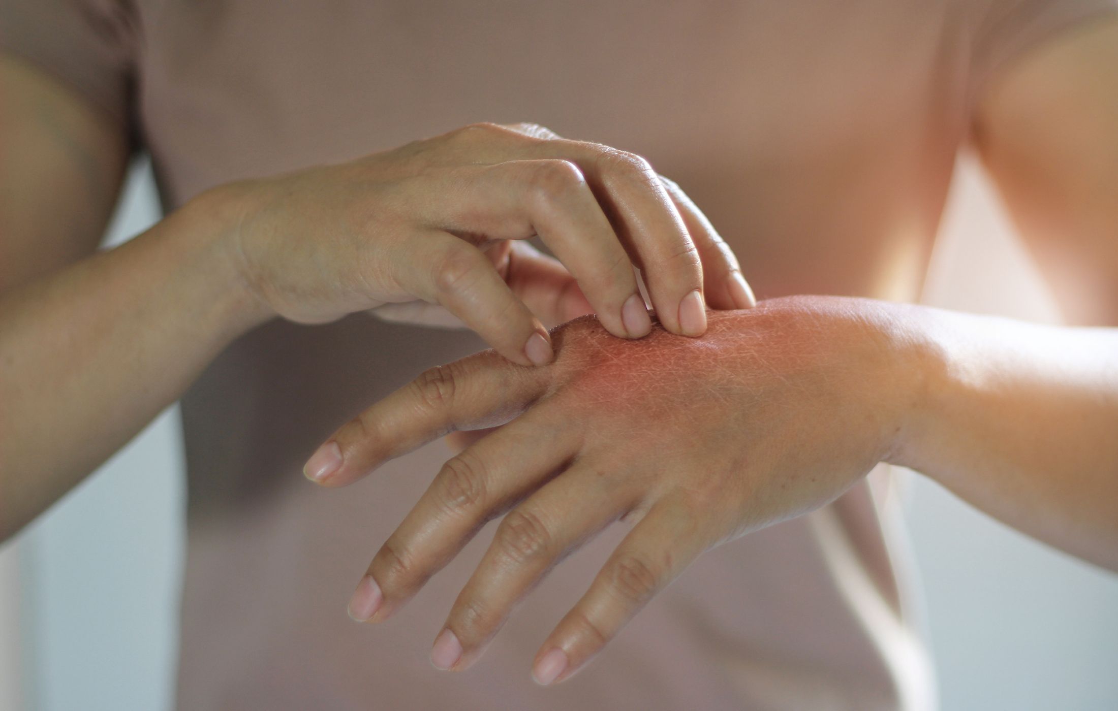 Psoriasis vs. Eczema: How to Tell the Difference