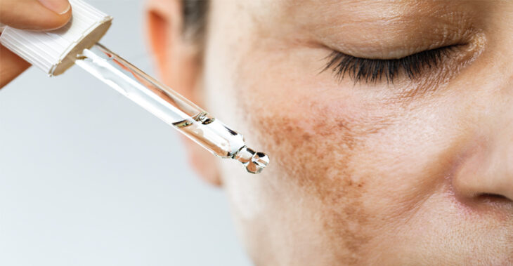 A Deep Dive Into the Frustrating World of Dark Spots