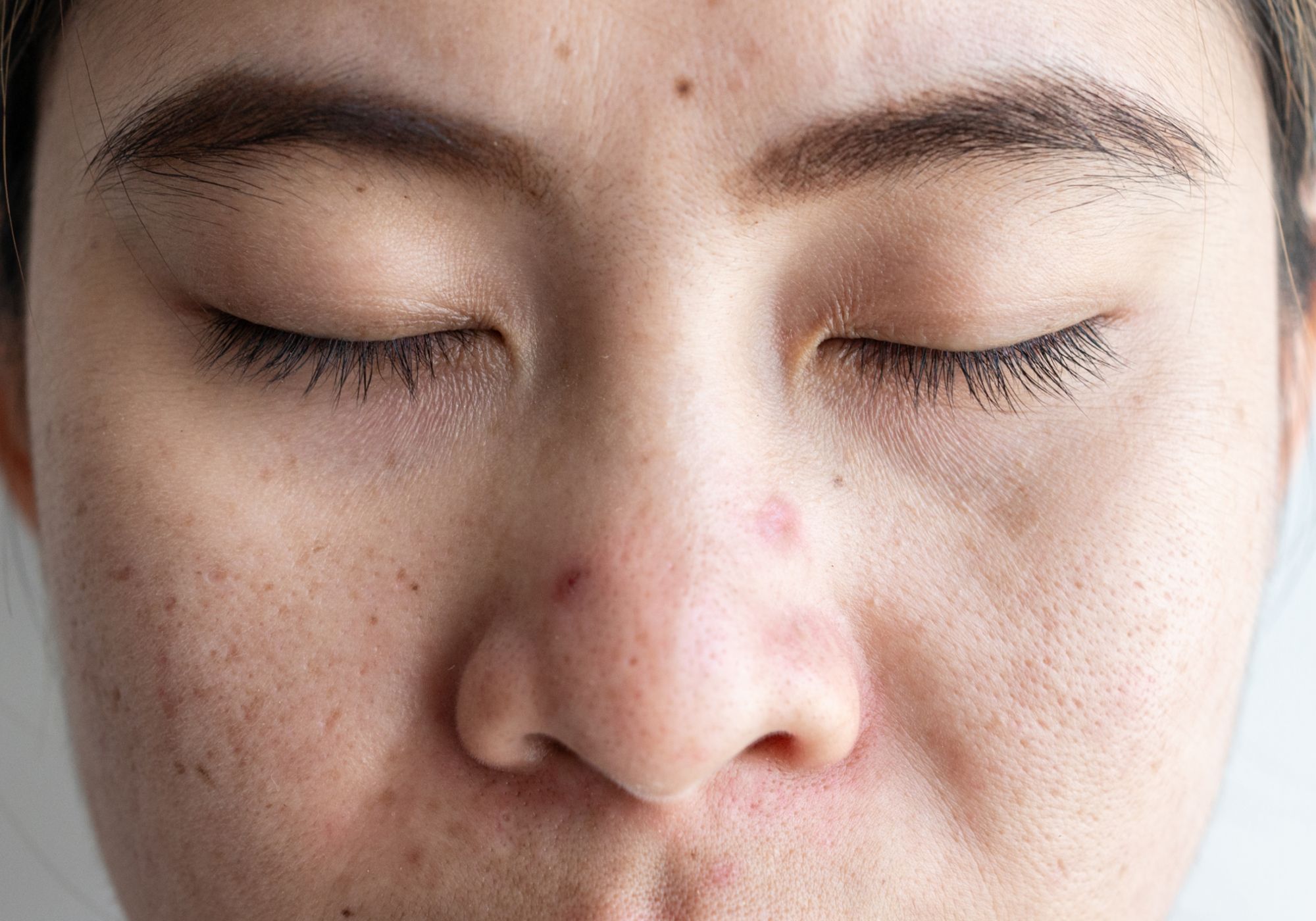 Struggling to Sleep? Dermatologists Say Your Acne Could Be the Culprit
