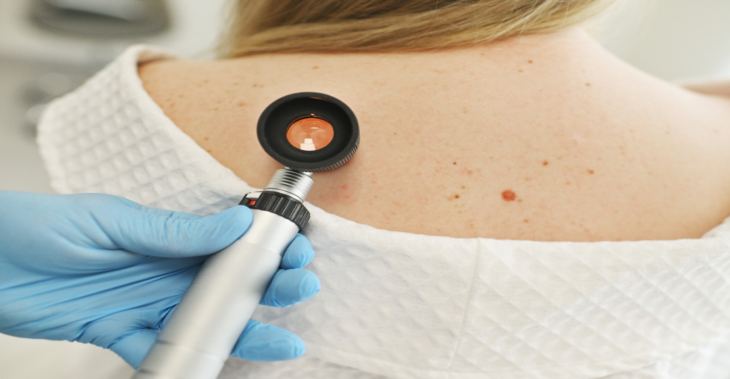 The Uncommon Signs of Skin Cancer Doctors Want You to Know