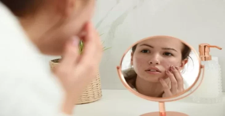 Iodine for Acne: Does the Viral TikTok Trend Really Work or Can It Be Harmful?