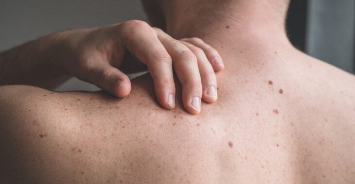 The 2026 Melanoma Numbers Are in, and They’re Alarming